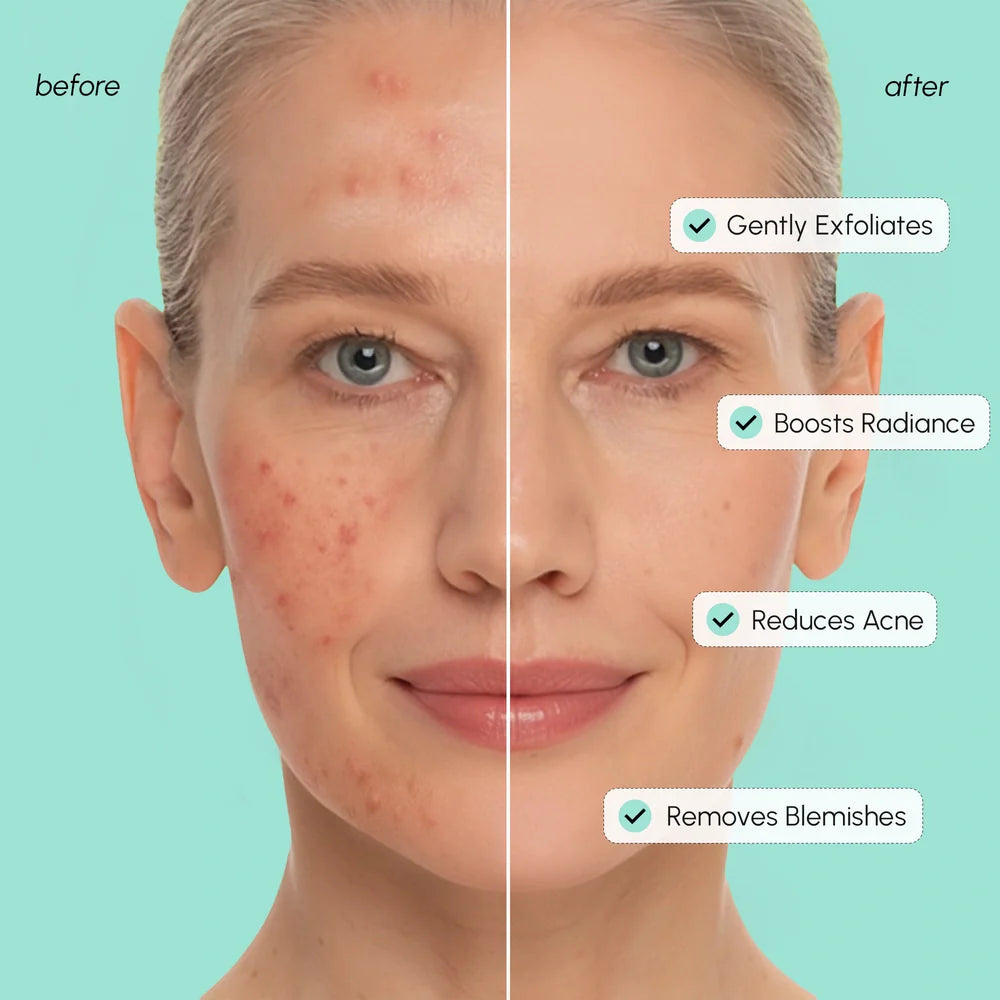 Azelaic Acid Soothing Pads by Marée®